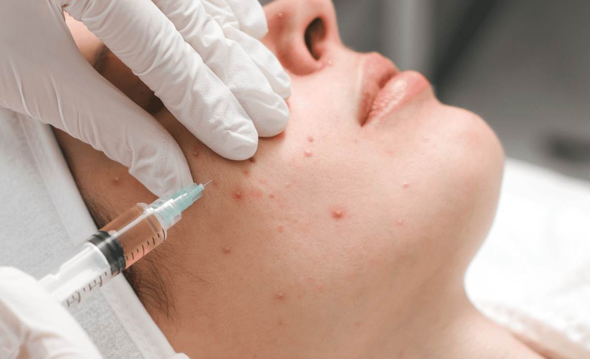 Acne Treatment for clear skin