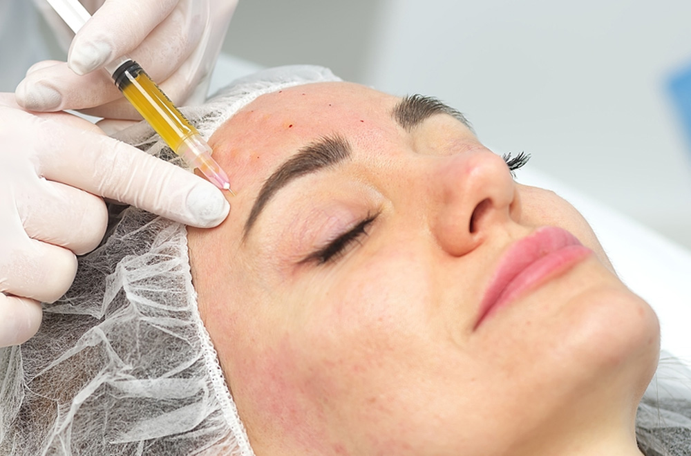 meso btx for acne reduction