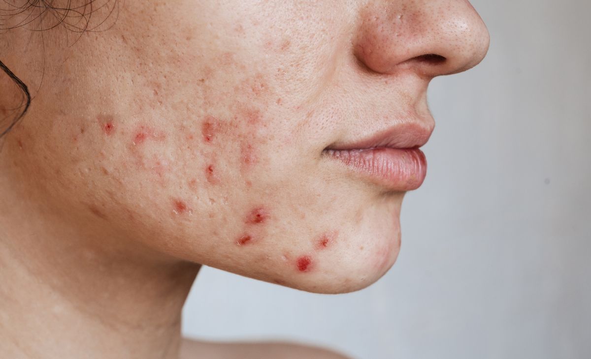Acne Scar Treatment
