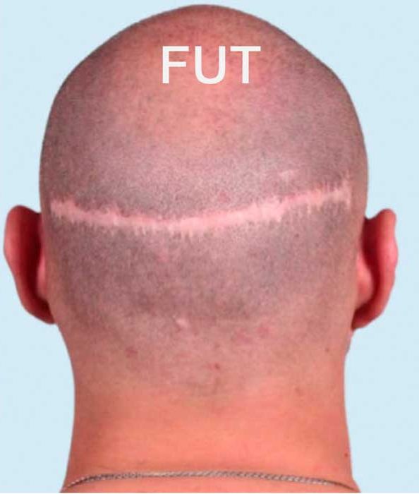 FUT hair restoration results