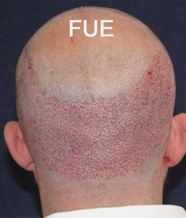 FUE hair restoration results
