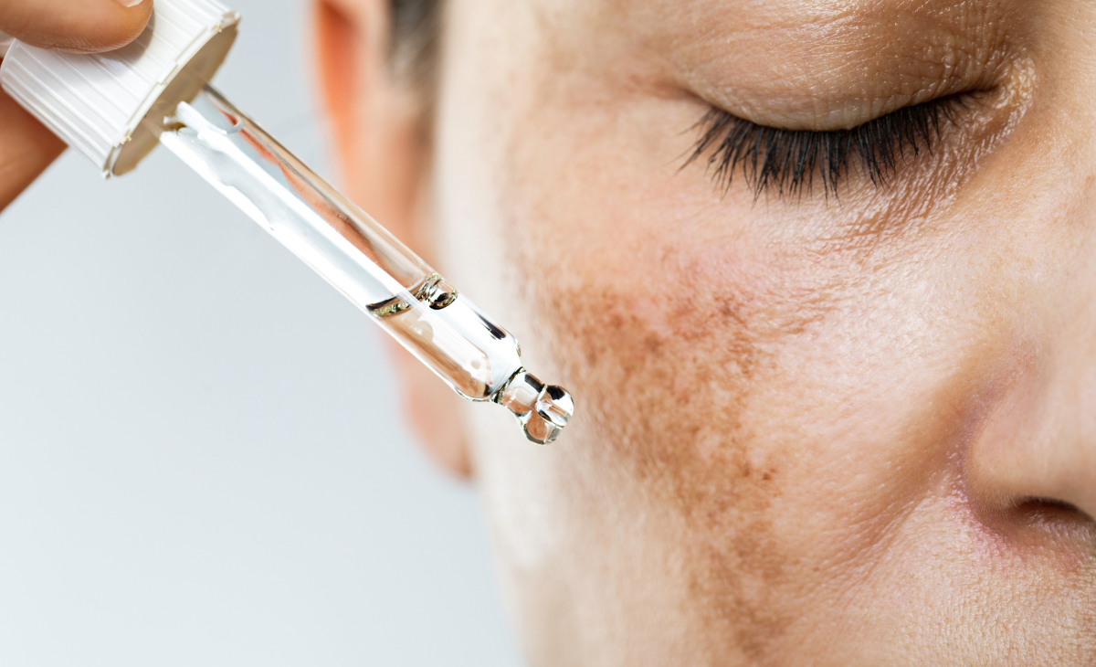 Hyperpigmentation Treatment