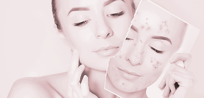 acne scar treatment