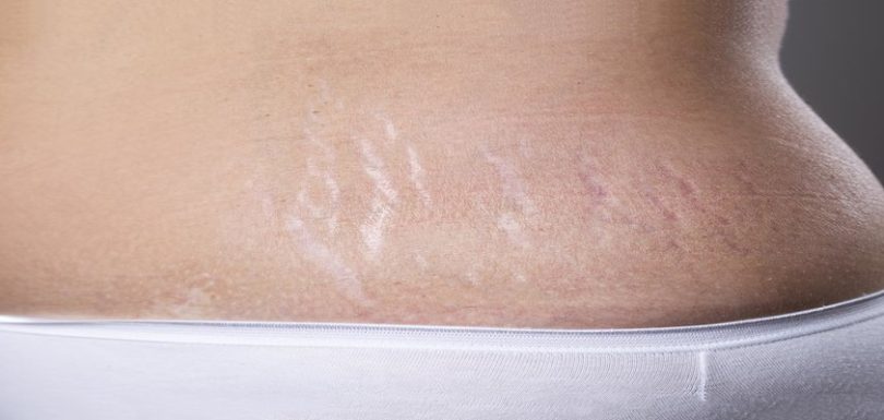 stretch marks