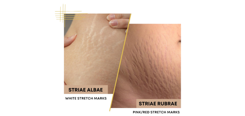 stretch marks treatment in Pakistan