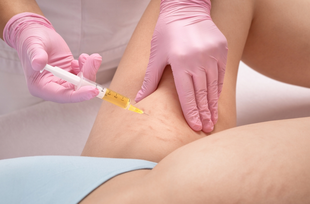 PRP (Platelet-Rich Plasma)