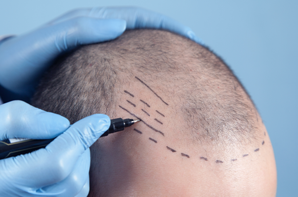 Stem Cell Hair Transplant