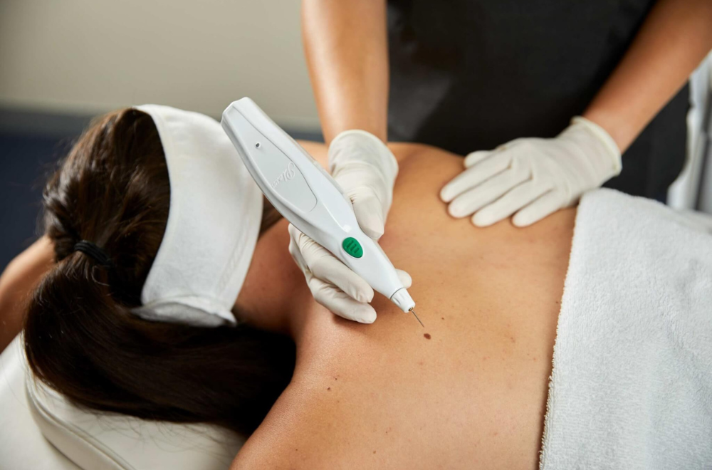 removal of mole with plexr therapy