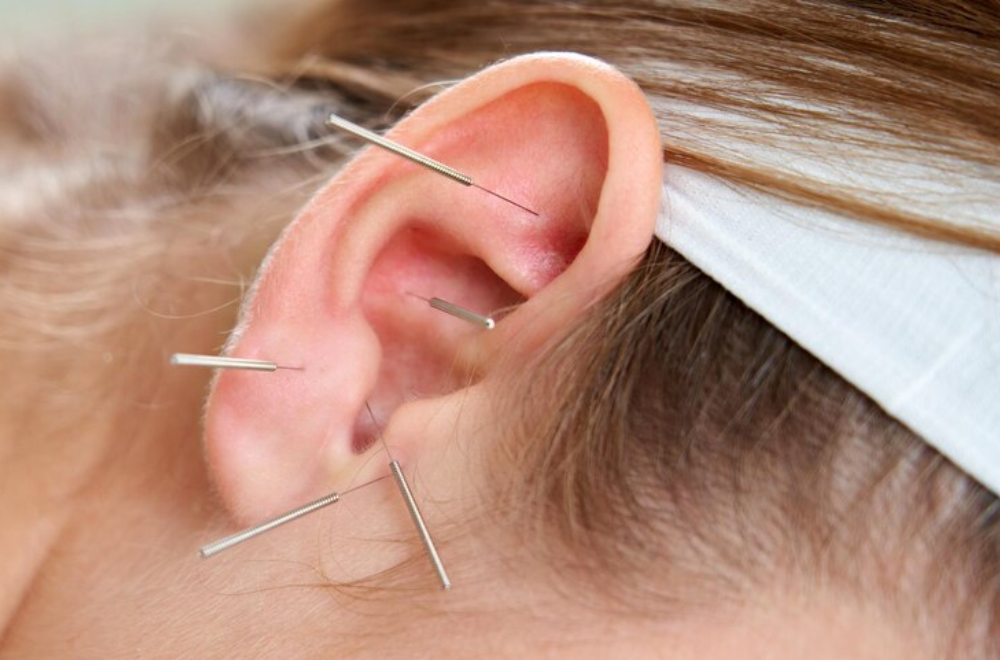 auricular ( ear) acupuncture