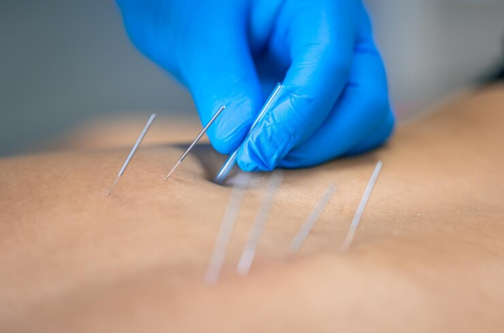 trigger point acupuncture