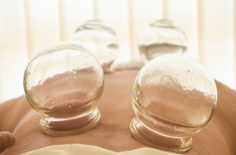 Hijama- Dry cupping therapy