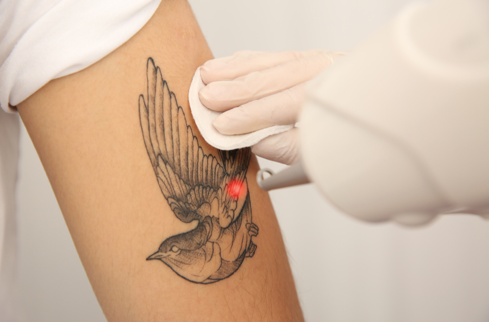 q-switched laser tattoo removal