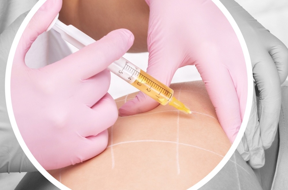 Dermal Fillers for Stretch Mark Reduction