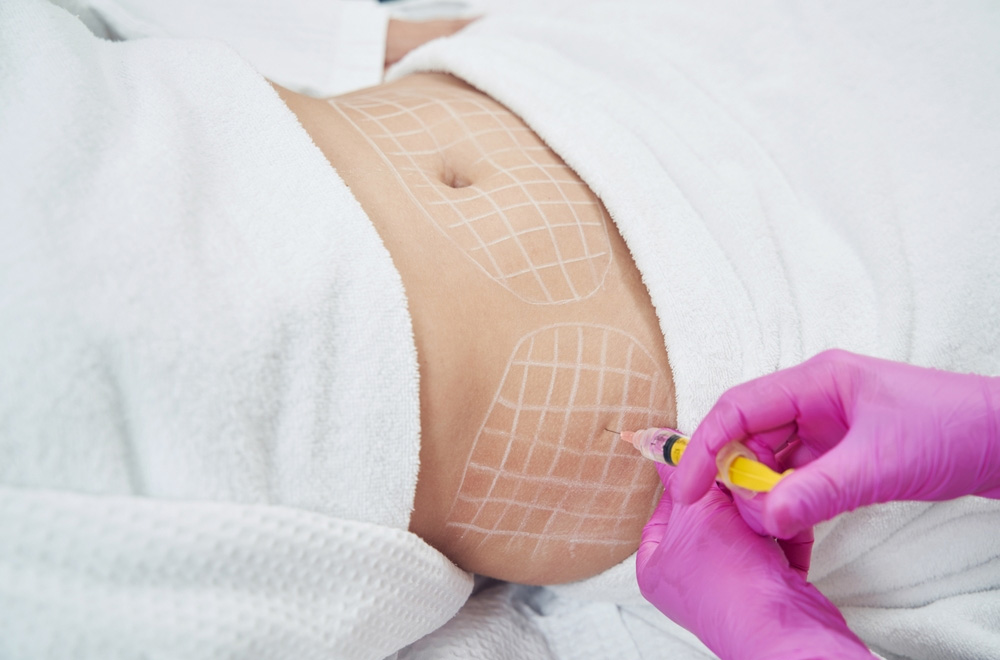 Injection Lipolysis (Fat Dissolving)