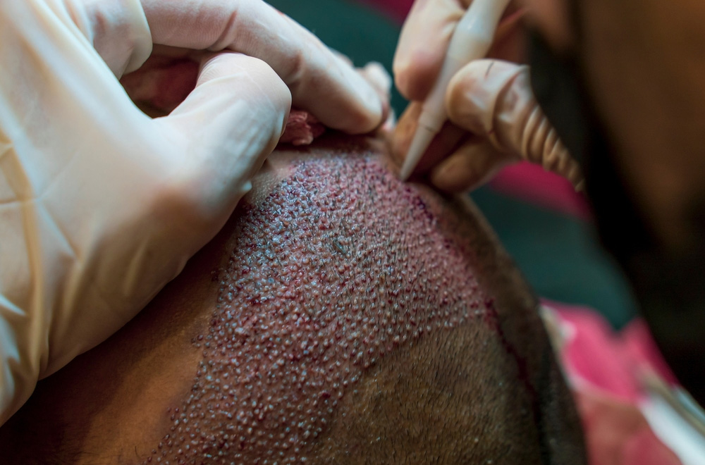 FUE Hair Transplant