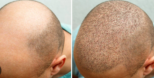 hair transplant treatment in pakistan