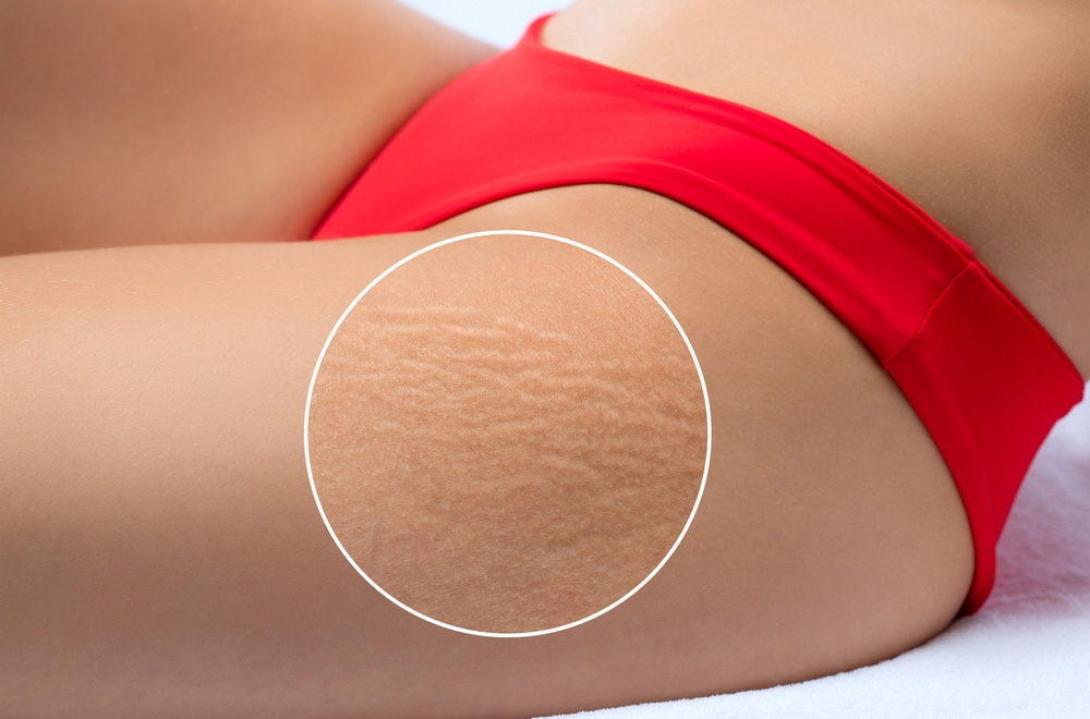 stretch marks-Plexr Plasma Therapy