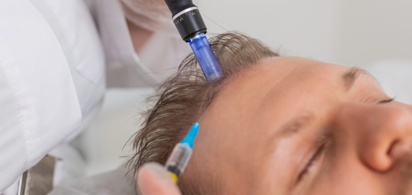 exosome for hair loss