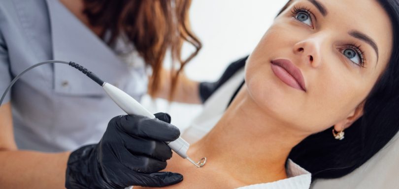 Safe and Painless mole removal treatment