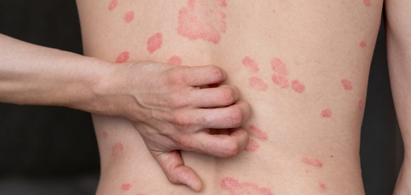 Healthier skin with Psoriasis treatment