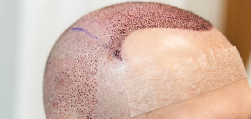 hair transplant in pakistan