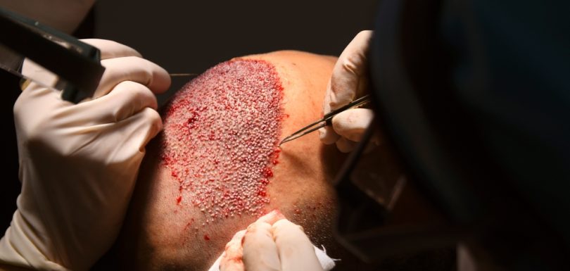 Natural and permanent hair restoration