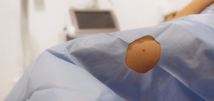 Mole Removal Treatment in Pakistan