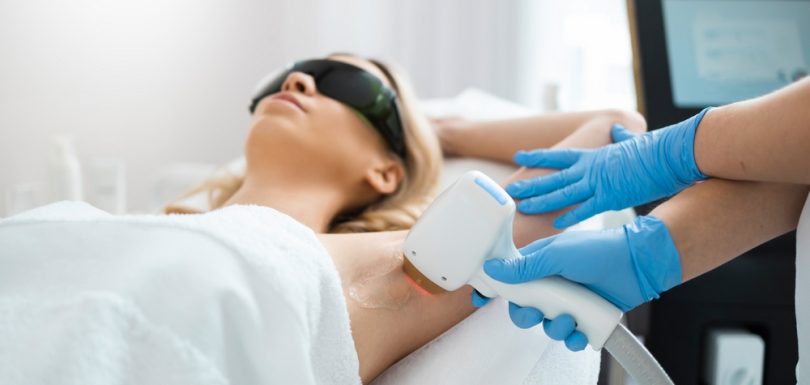 laser hair removal