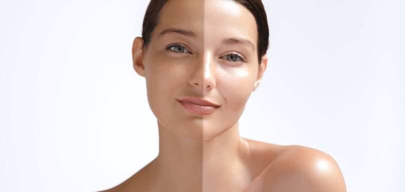 skin whitening treatment