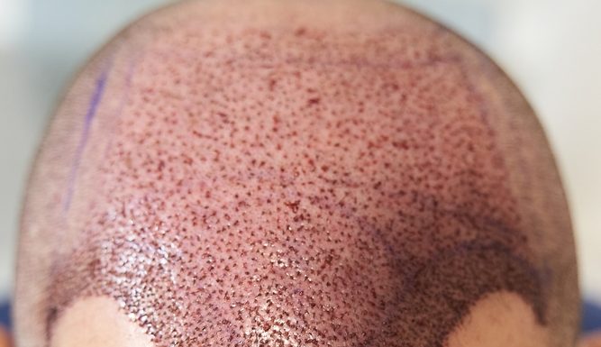 Hair Transplant Treatment