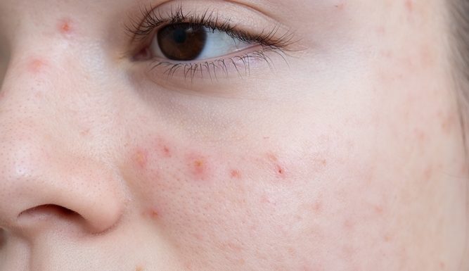 Acne treatment in lahore