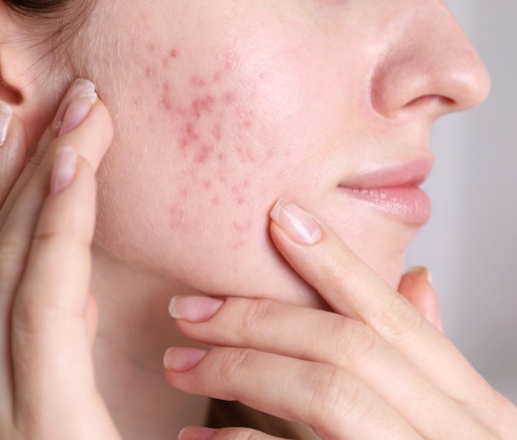 acne scars treatment in faisalabad
