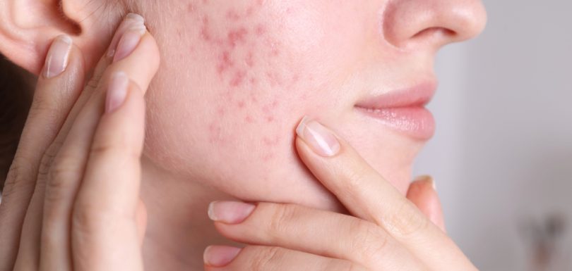 acne scars treatment in faisalabad